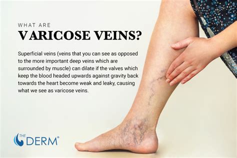 Varicose Veins: What’s the Deal and How to Heal - The Derm ...