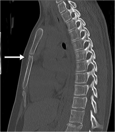 Pediatric sternal fractures from a Level 1 trauma center - Journal of ...