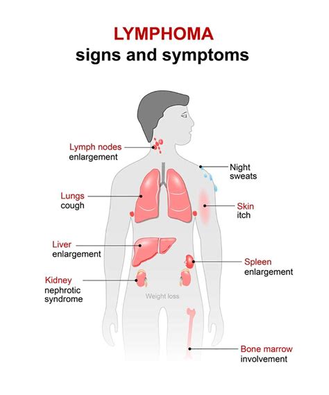 Lymphoma Symptoms - 9 Signs of Hodgkin's & Non-Hodgkin's lymphoma!