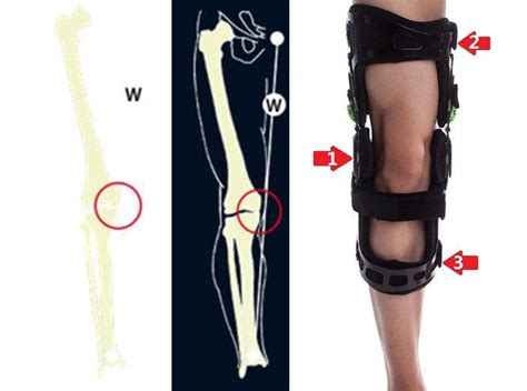 What causes OA? How does a knee brace help? - Valgus / Varus | Knee ...