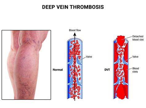 Deep Vein Thrombosis (DVT) - Vein & Endovascular Medical Care