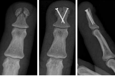 Distal Phalanx Fracture