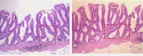 GASTROINTESTINAL AND LIVER HISTOLOGY PATHOLOGY ATLAS: SESSILE SERRATED ...