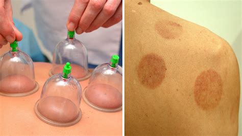 What Is Cupping Treatment? Man Left With Bruises After Cupping | Allure