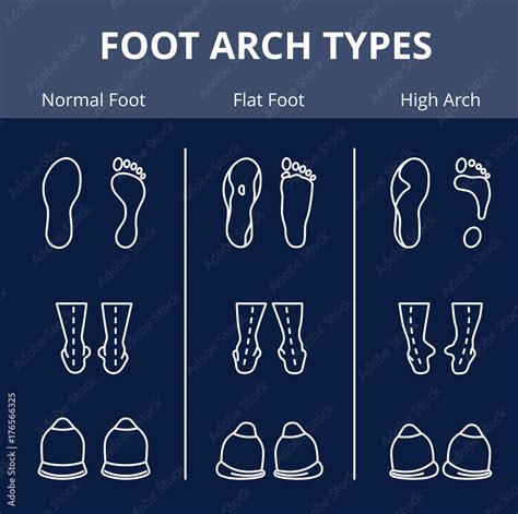 Foot arch types vector infographics. Set of flat foot, high arch Stock ...