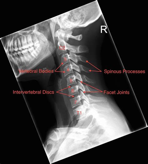 check out my Xrays and tell me what you think - General Discussion ...