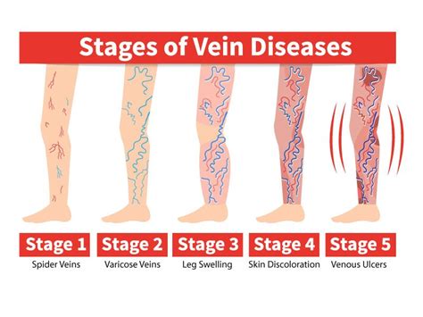 The Stages of Vein Disease — Physicians Vein Clinics