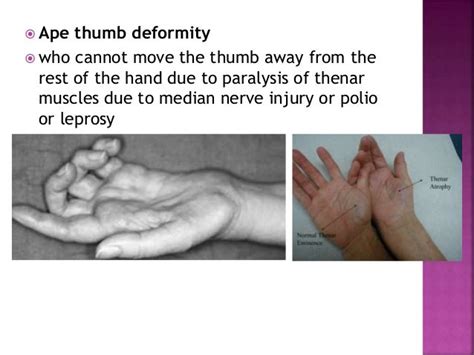 Ape Hand Deformity