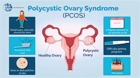 Polycystic Ovary Syndrome (PCOS): Causes, Signs, and Symptoms | Lab ...