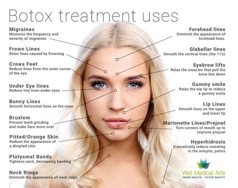 Image result for before and after pictures for botox for DAO # ...