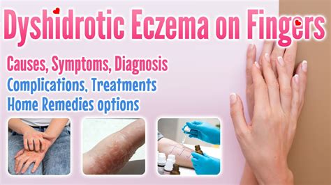 Dyshidrotic eczema on fingers overview, causes, symptoms, treatment ...