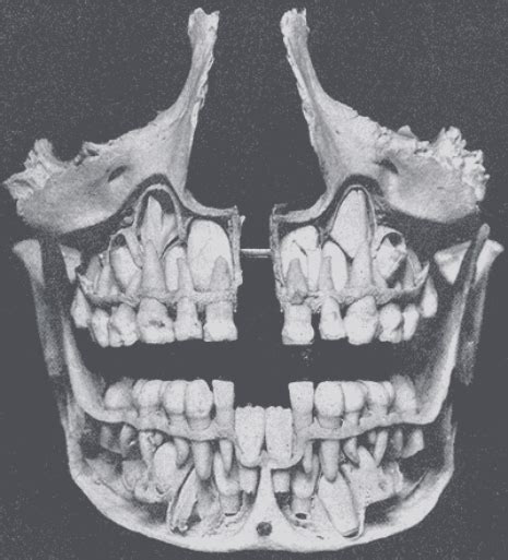 X- rays of kid's skulls as their baby teeth get pushed out. | Teeth art ...