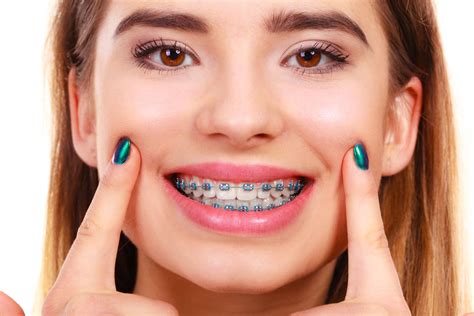 Woman smiling showing teeth with braces