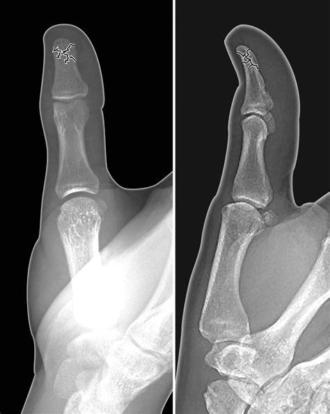 THUMB DISTAL PHALANX FRACTURE | Hand Surgery Resource