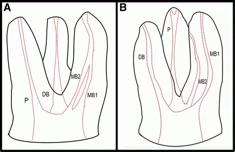 Maxillary Molar Root Canal Morphology and Anatomy | Key Topics in ...