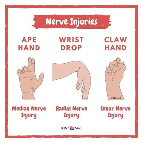 Pin by Gi Ft on Anatomy in 2020 (With images) | Median nerve, Nursing ...