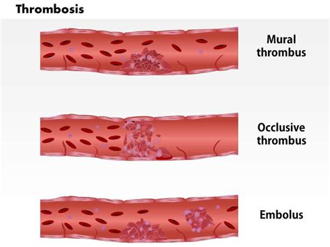 0814 Types Of Thrombosis Medical Images For Powerpoint | Presentation ...