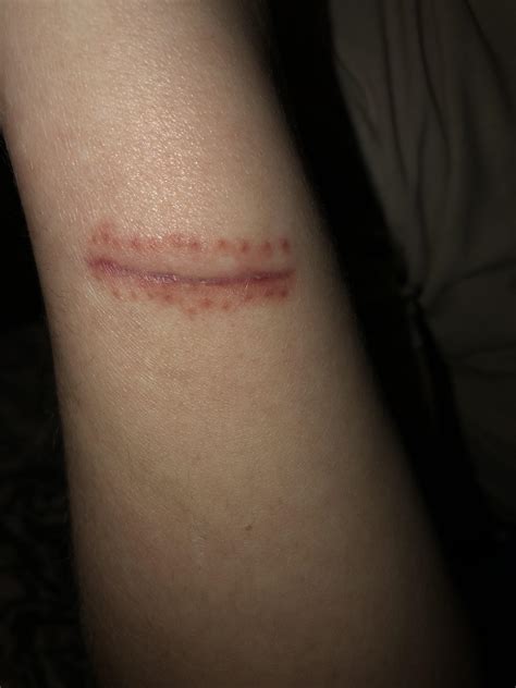 Dog bite: side of wrist : r/scars