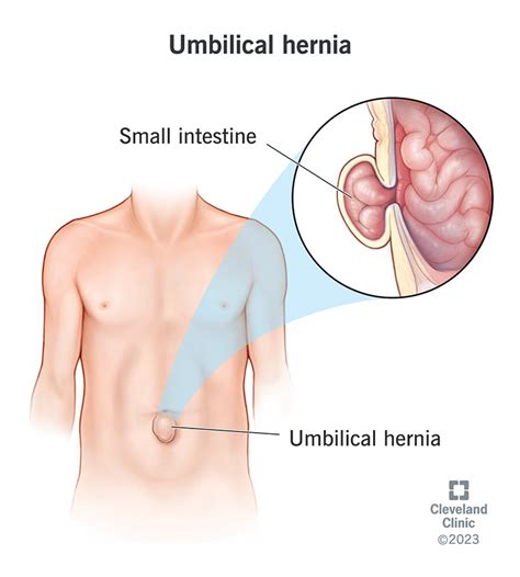 Umbilical Hernia: Symptoms, What It Is, Treatment & Surgery