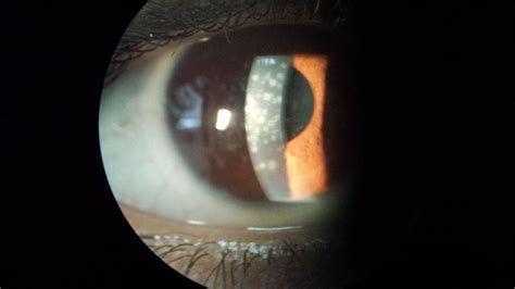 Medicine:Nummular keratitis - HandWiki