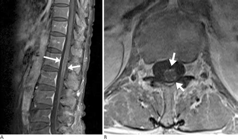 Cauda Equina Syndrome On Mri