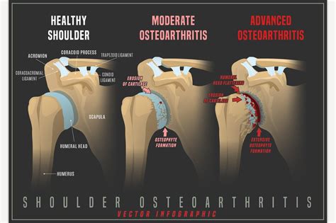 Shoulder osteoarthritis infographic | Healthcare Illustrations ...