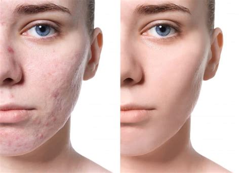 How Can I Get Rid of Acne Scars? | Lake Jackson ENT & Med Spa | Blog