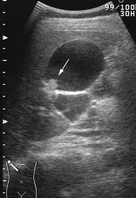 Gallbladder Polyps Ultrasound