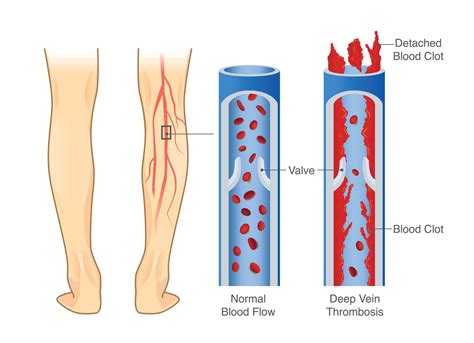 Superficial Venous Thrombosis