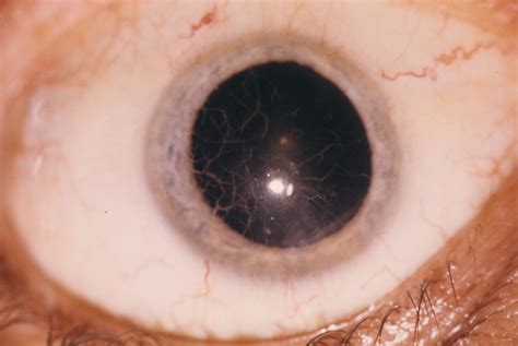 Corneal Dystrophy, Lattice Type I | Hereditary Ocular Diseases