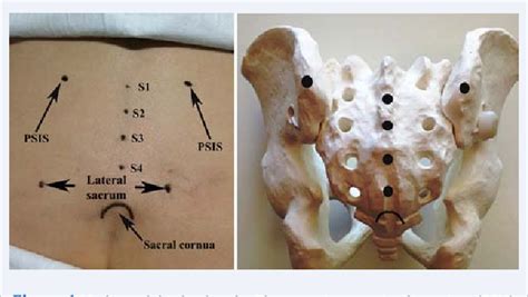 Ultrasound Sacroiliac Joint Injection