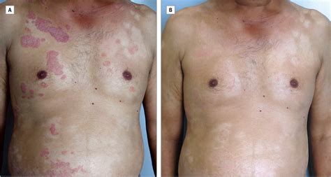 Efficacy of Novel Topical Liposomal Formulation of Cyclosporine in ...