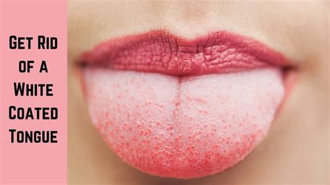 Natural Remedies to Get Rid of a White Coated Tongue