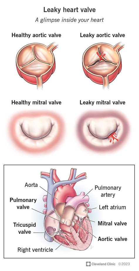 Mitral Valve Stenosis: Symptoms Treatment, 58% OFF