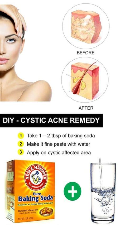 DIY Remedies for Cystic Acne