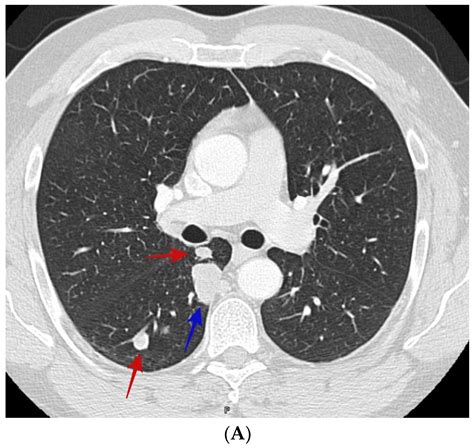 5mm Lung Nodule Right