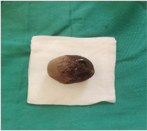 Bladder stone after removal. | Download Scientific Diagram