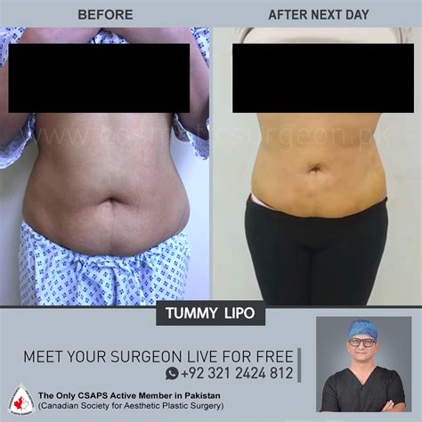 Liposuction Before & After Surgery - Cosmetic Surgeon