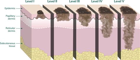 Melanoma Stage 0