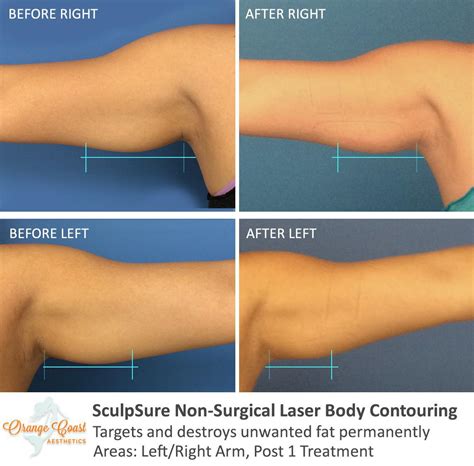 SculpSure Before and After Photos - Orange Coast Aesthetics