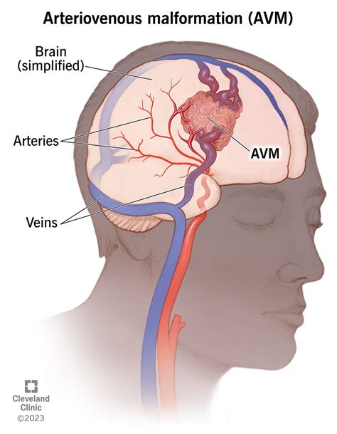 Arteriovenous Malformation (AVM): Causes & Symptoms