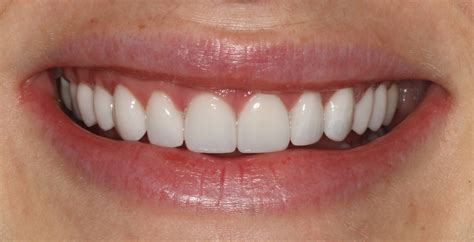 Beautiful Smile with Porcelain Veneers at SmilesNY