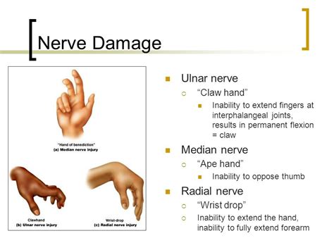 Claw Hand, or 'Spinster's Claw #medical article #anatomy - LANKA STUDENTS