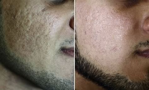 Fractionated Ablative CO2 Laser Resurfacing | Western Dermatology