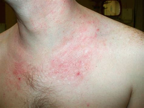 Atopic dermatitis causes, symptoms, diagnosis, treatment & prognosis