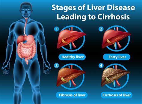 Liver Cirrhosis Stage 1