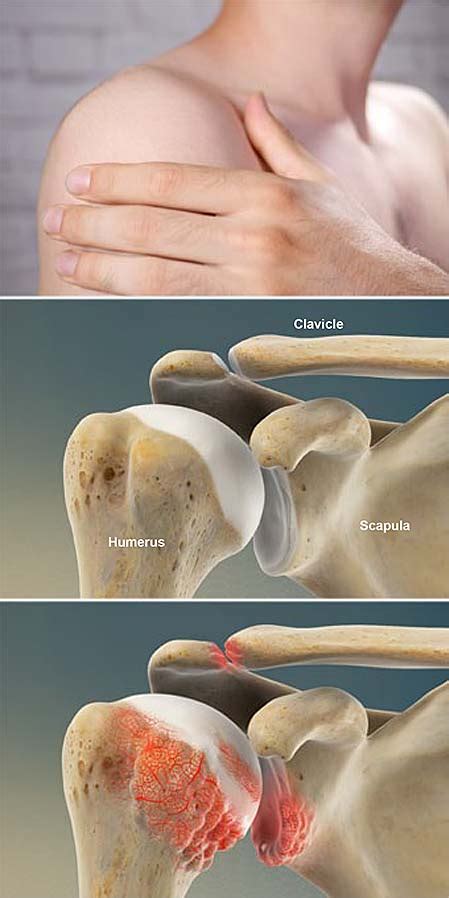 Rheumatoid Arthritis (RA) of the Shoulder | Central Coast Orthopedic ...