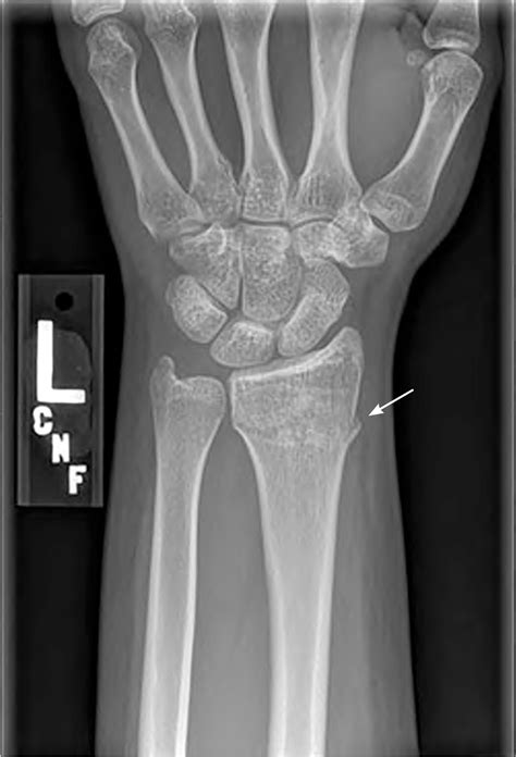 Radius Fracture