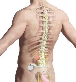 Spinal Cord Stimulation Newport Beach, CA | Arachnoiditis Newport Beach, CA