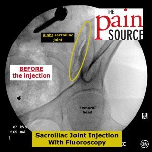 Sacroiliac Joint Injection With Fluoroscopy - Technique and Tips - The ...